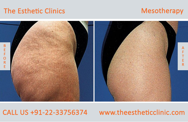 Mesotherapy for Hair Loss Face Skin Treatment before after photos in mumbai india (4)